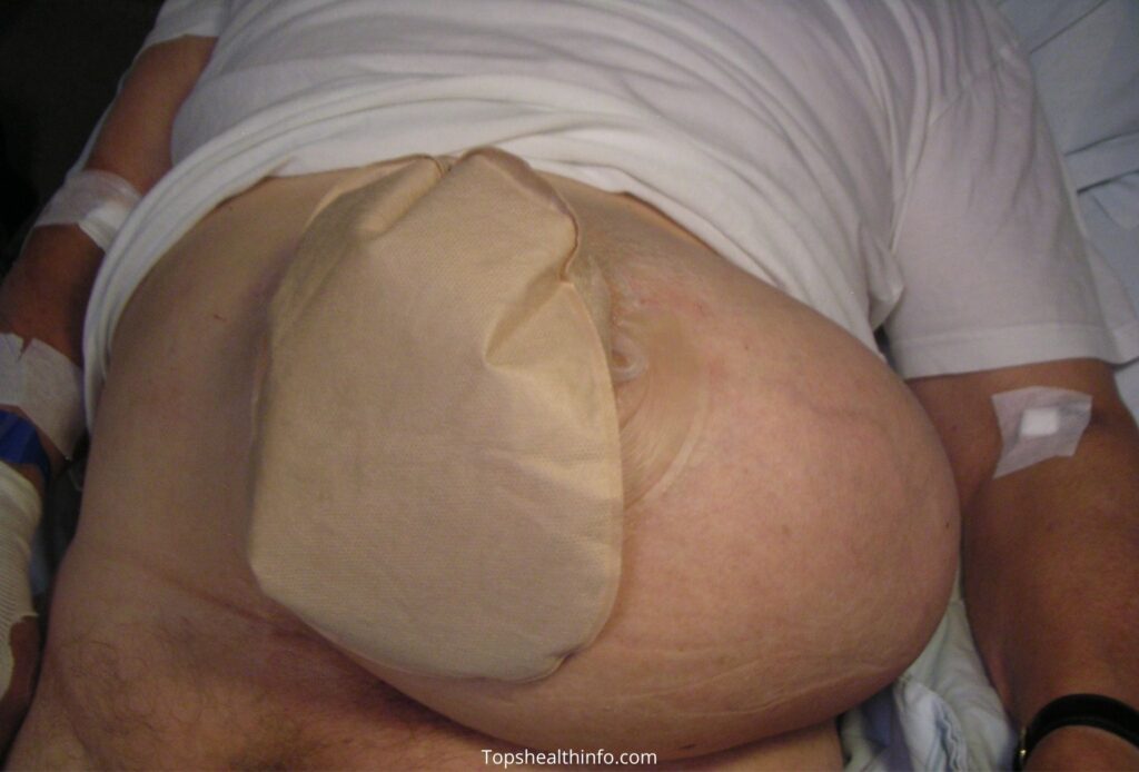 How to Protect the Colostomy Bag