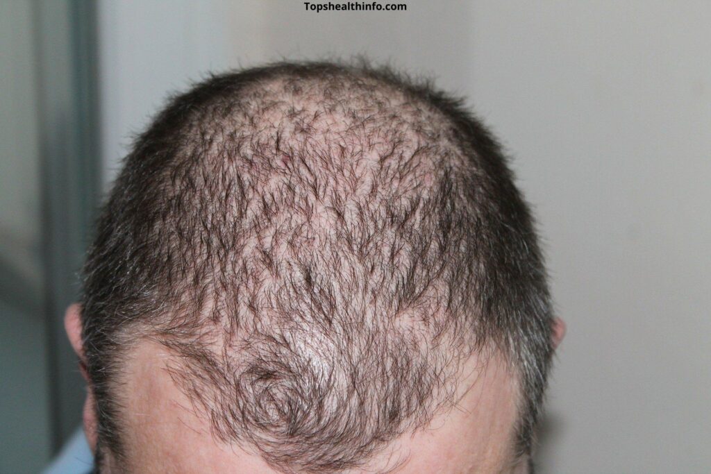 Need to Know About Hair Transplant