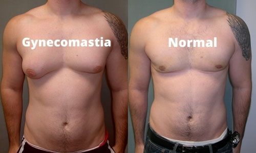 Gynecomastia in Jacksonville, FL - PVPS