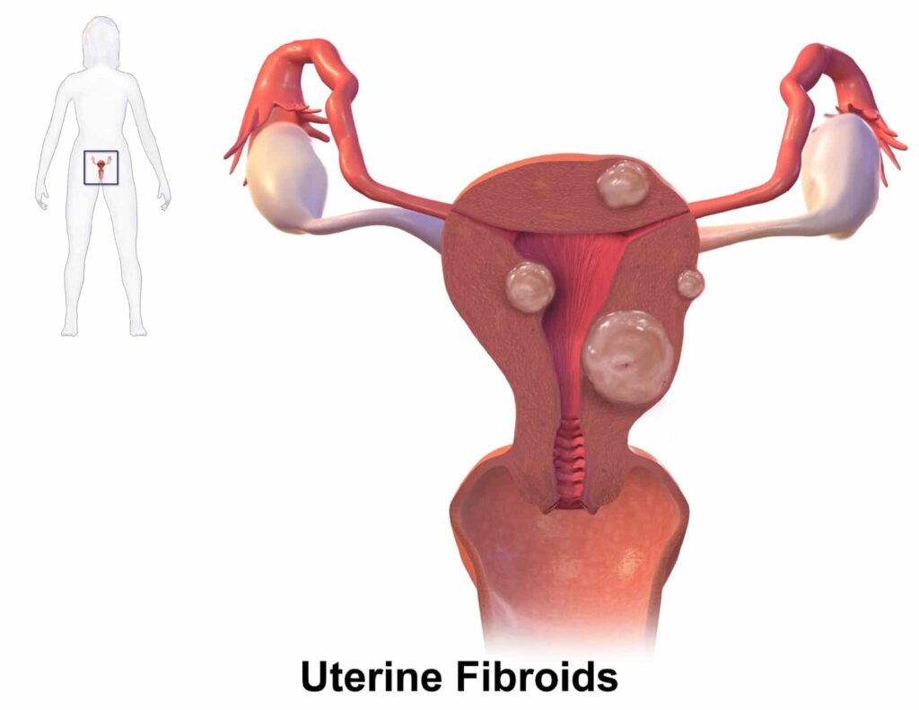 Uterine Fibroids Causes, Symptoms, and Natural Treatments