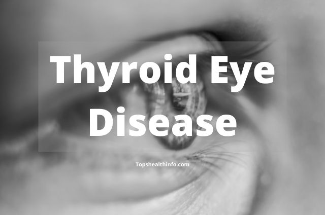 Thyroid Eye Disease