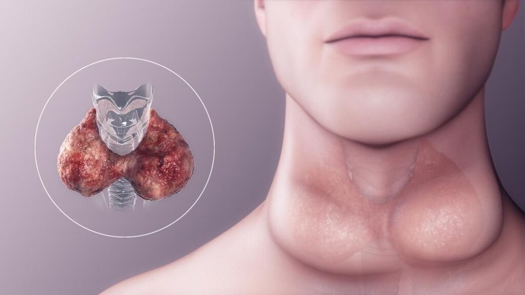 Natural Ways of Dealing with Hypothyroidism 