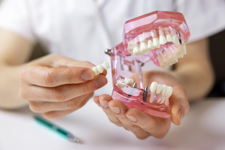 Dental Implant Procedure