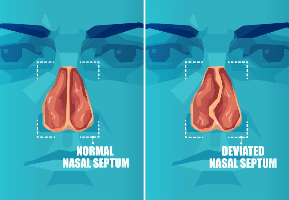 Deviated Septum