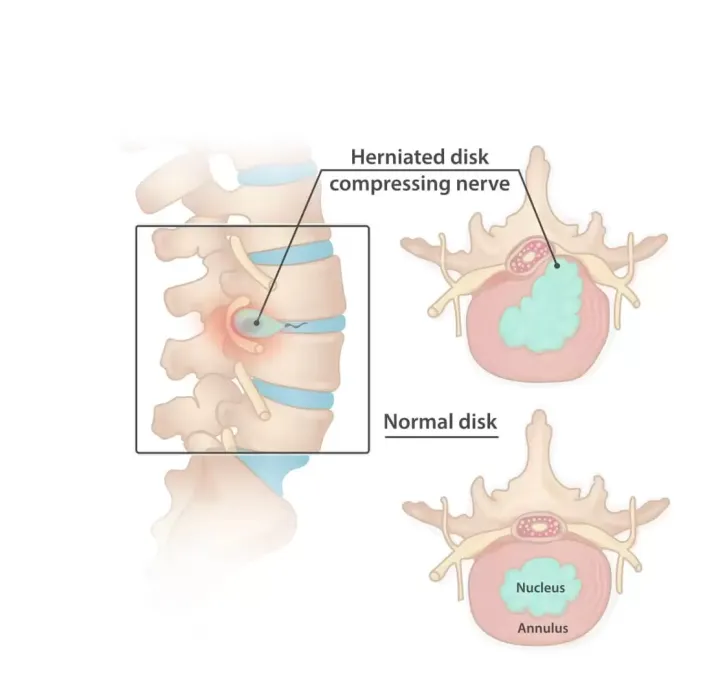 Diffrence between Normal disk and Herniated Disc