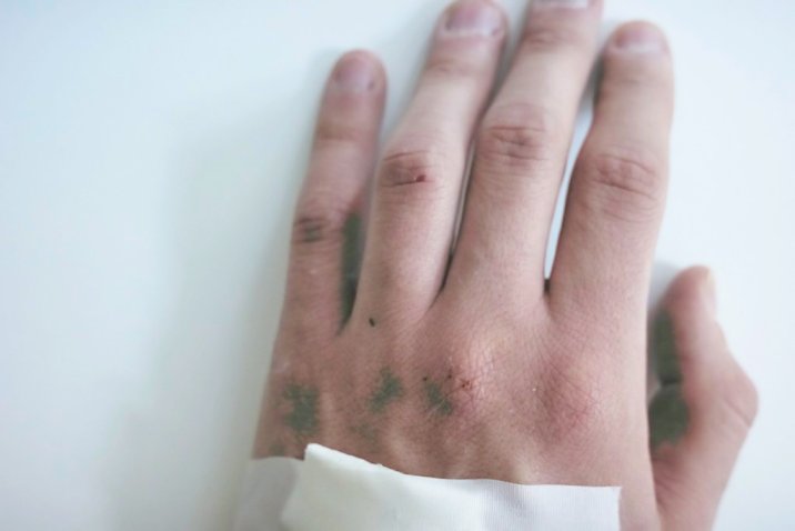 monkeypox rash on hand