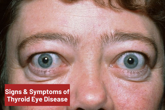 thyroid eye disease symptoms