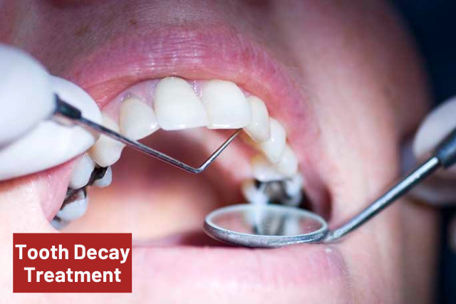 how to treat tooth decay 