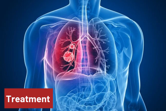 Lung cancer Treatments