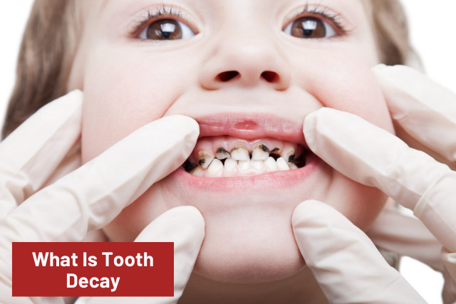 What is tooth decay 