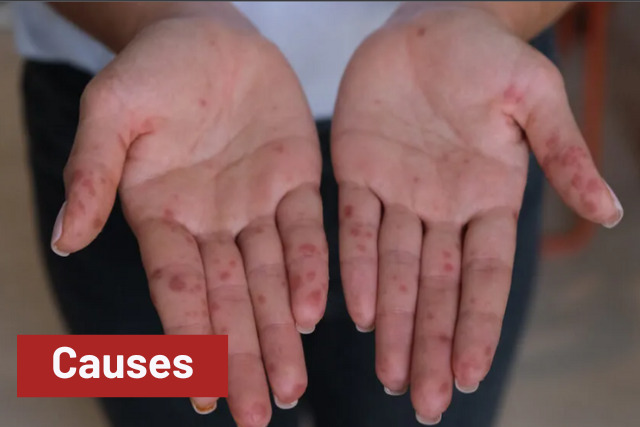 Hand, Foot And Mouth Disease Causes