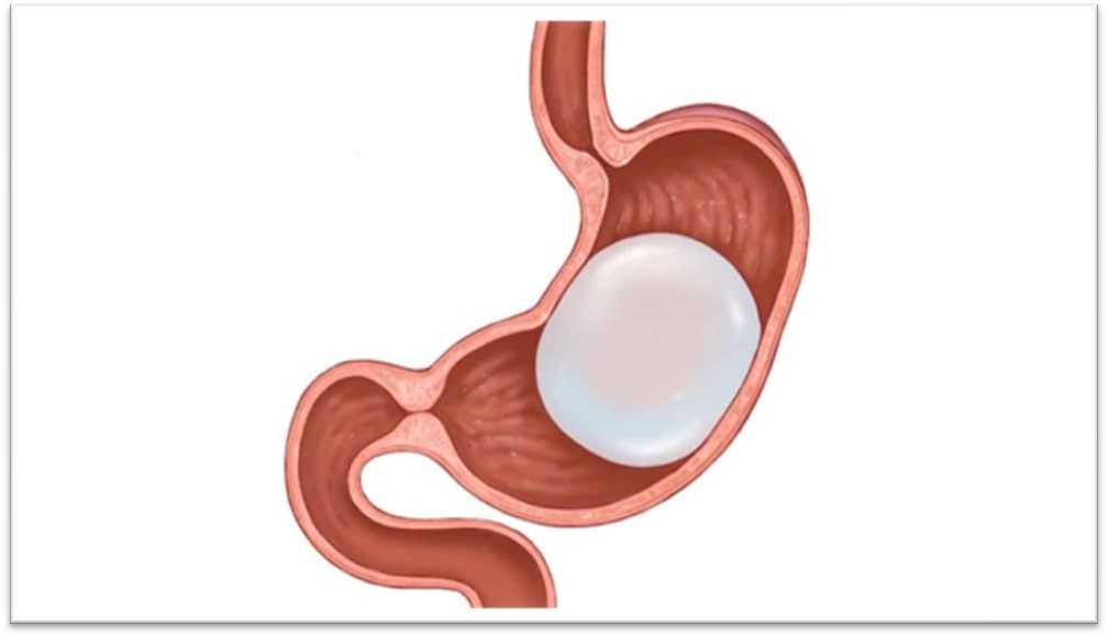 Gastric Balloon