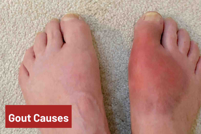 Gout Causes