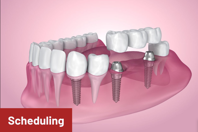 Dental Implant scheduling