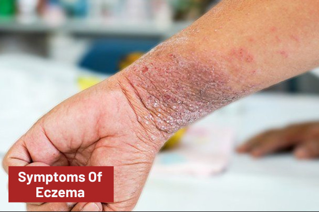 Eczema symptoms