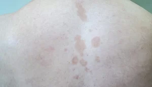 Fungus Rash on Chest