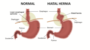 Symptoms of Hiatal Hernia: