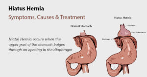 Treatment Hiatal Hernia 