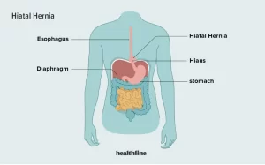 reatment Hiatal Hernia