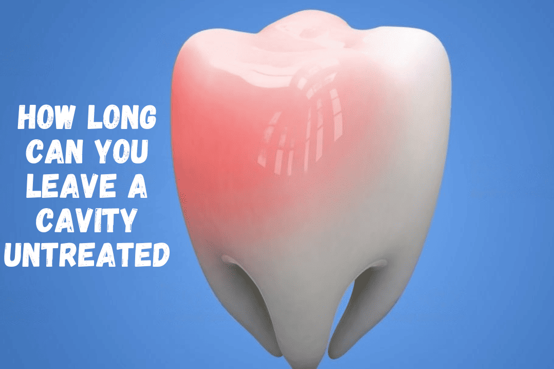 How Long Can You Leave a Cavity Untreated?