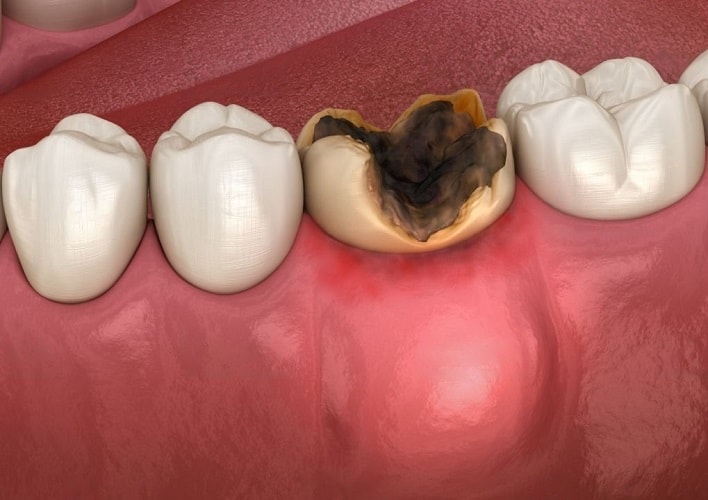 How Long Can You Leave a Cavity Untreated