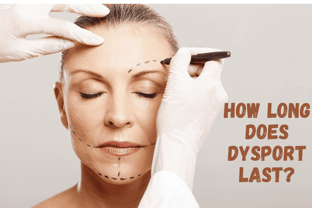 How Long Does Dysport Last?