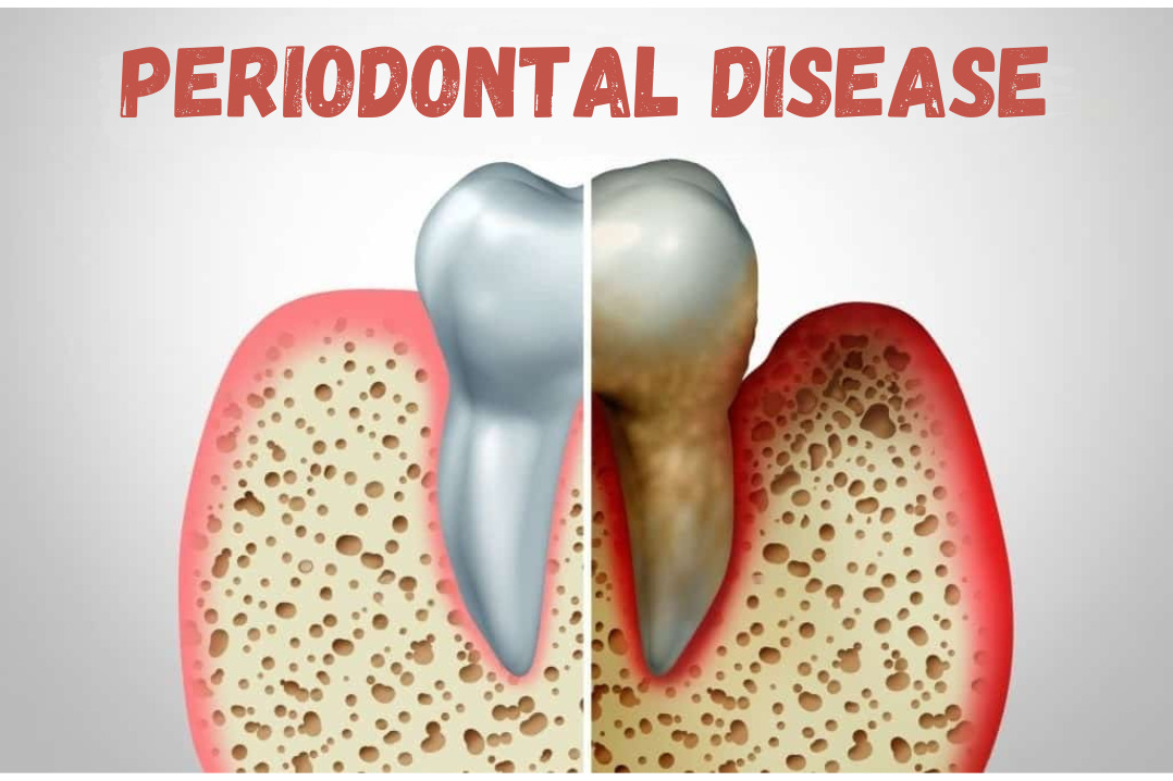 Periodontal Disease