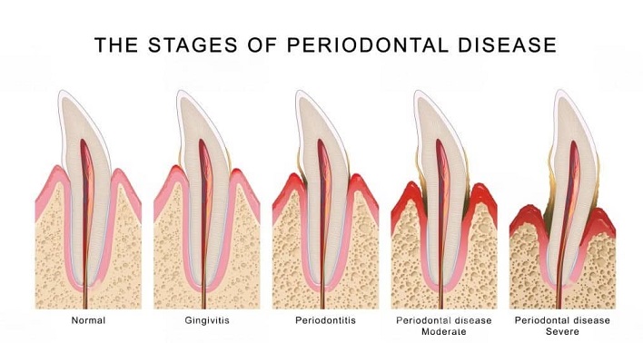 Stages of Periodontal Disease