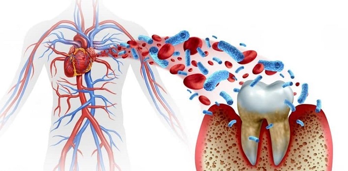 Periodontal Disease